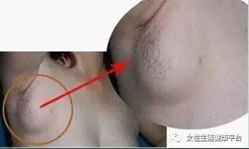 腋下副乳图片,成因、症状及预防措施